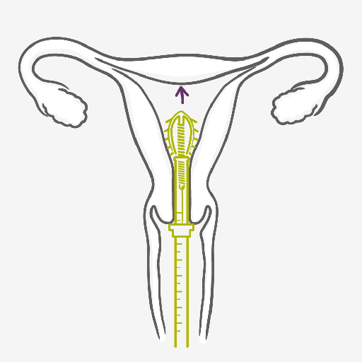How to use Intrauterine Device - IUD